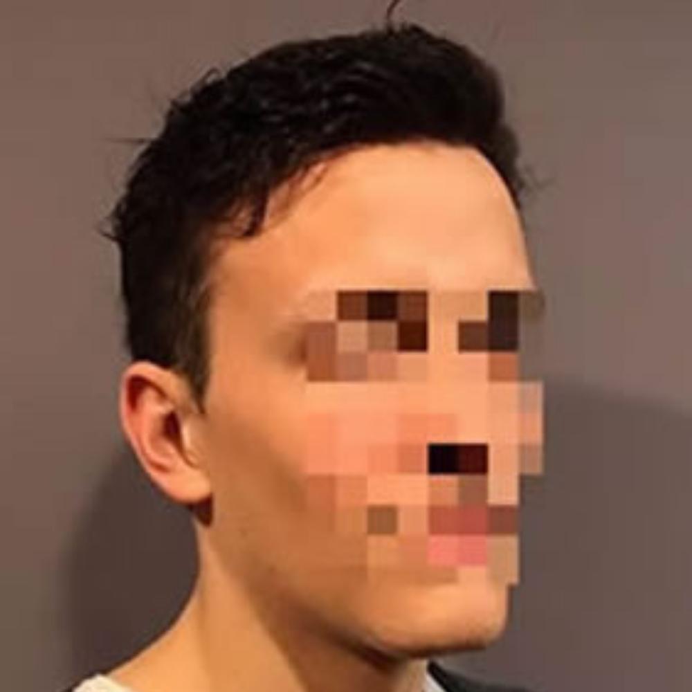 Men’s Hair System – After Men's Hair System - After