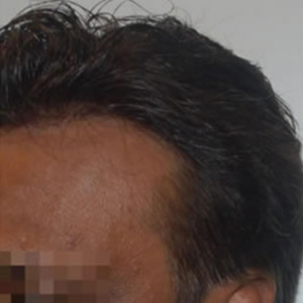 Men’s Hair System – After Men's Hair System - After