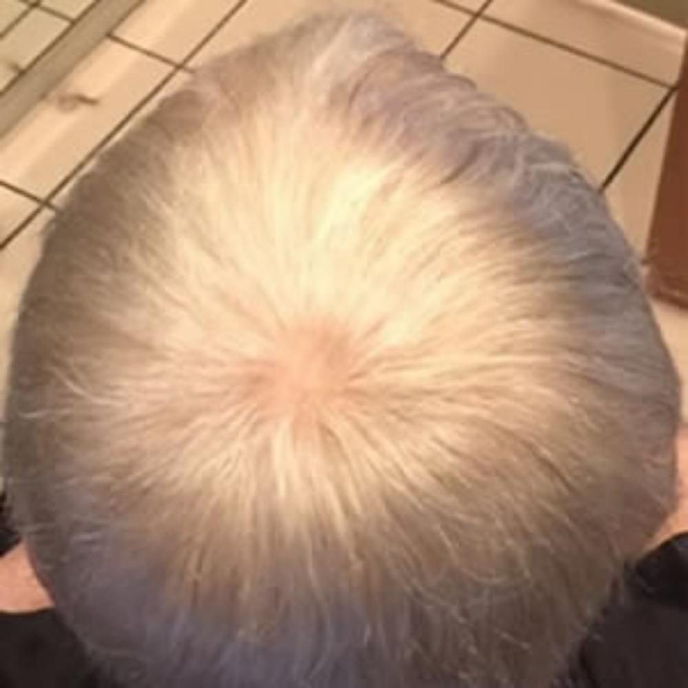 Men’s Hair System – After Men's Hair System - After