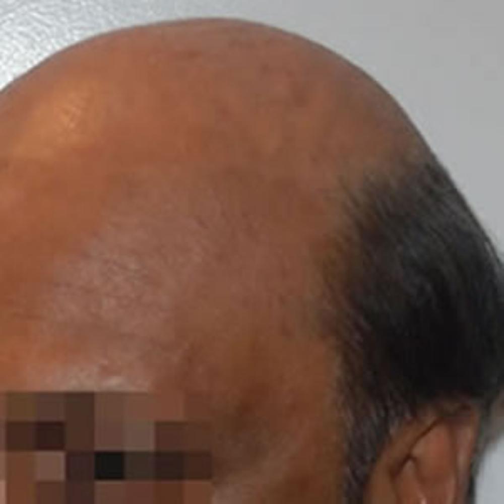 Men’s Hair System – Before Men's Hair System - Before