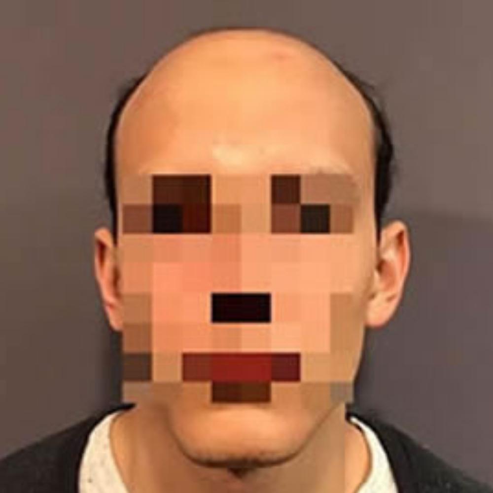 Men’s Hair System – Before Men's Hair System - Before