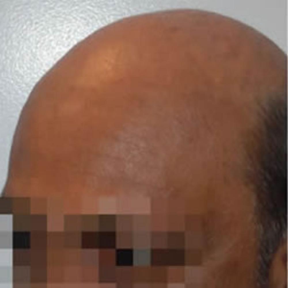 Men’s Hair System – Before Men's Hair System - Before