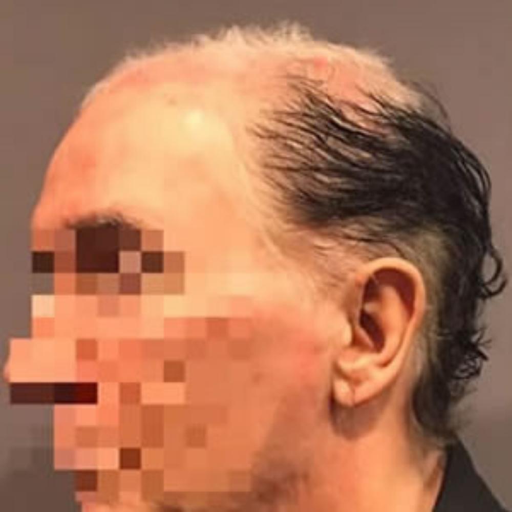 Men’s Hair System – Before Men's Hair System - Before