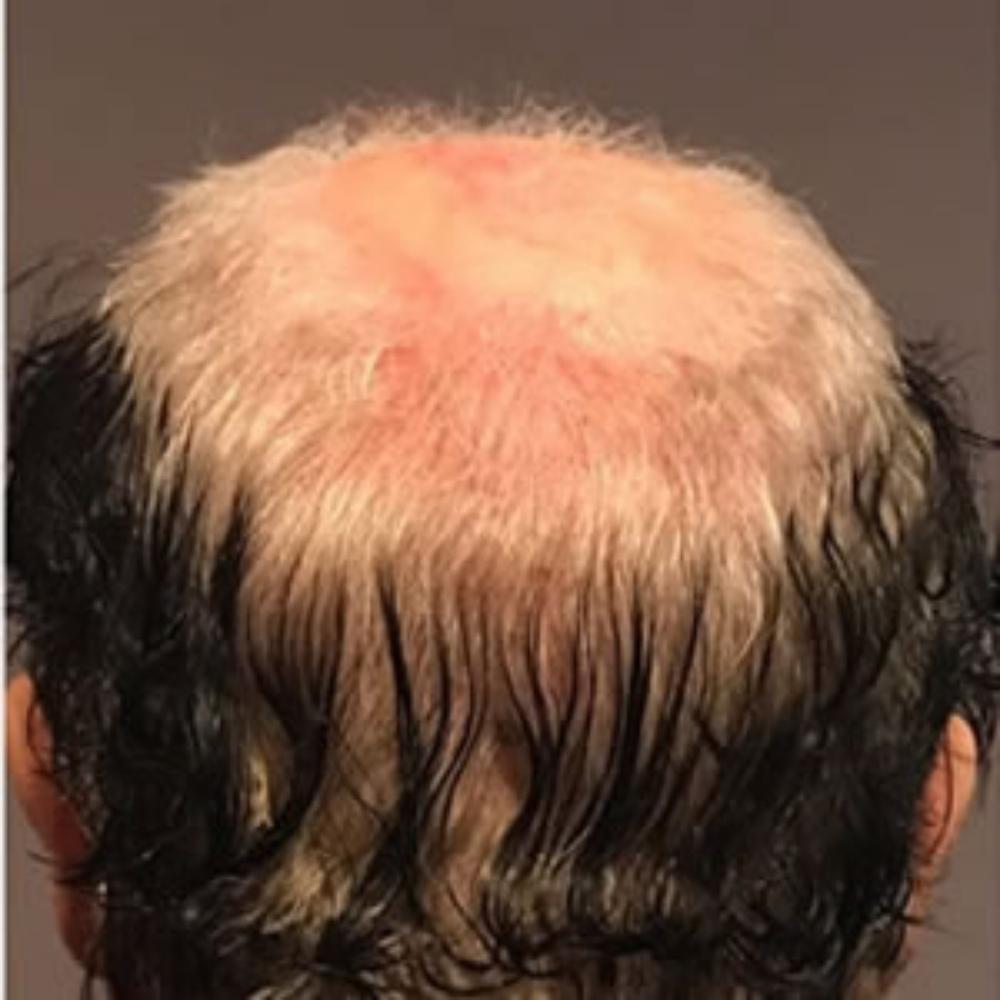 Men’s Hair System – Before Men's Hair System - Before