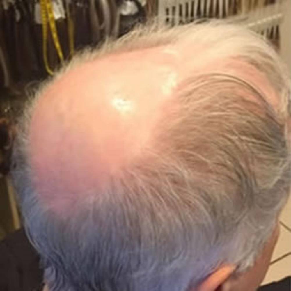 Men’s Hair System – Before Men's Hair System - Before