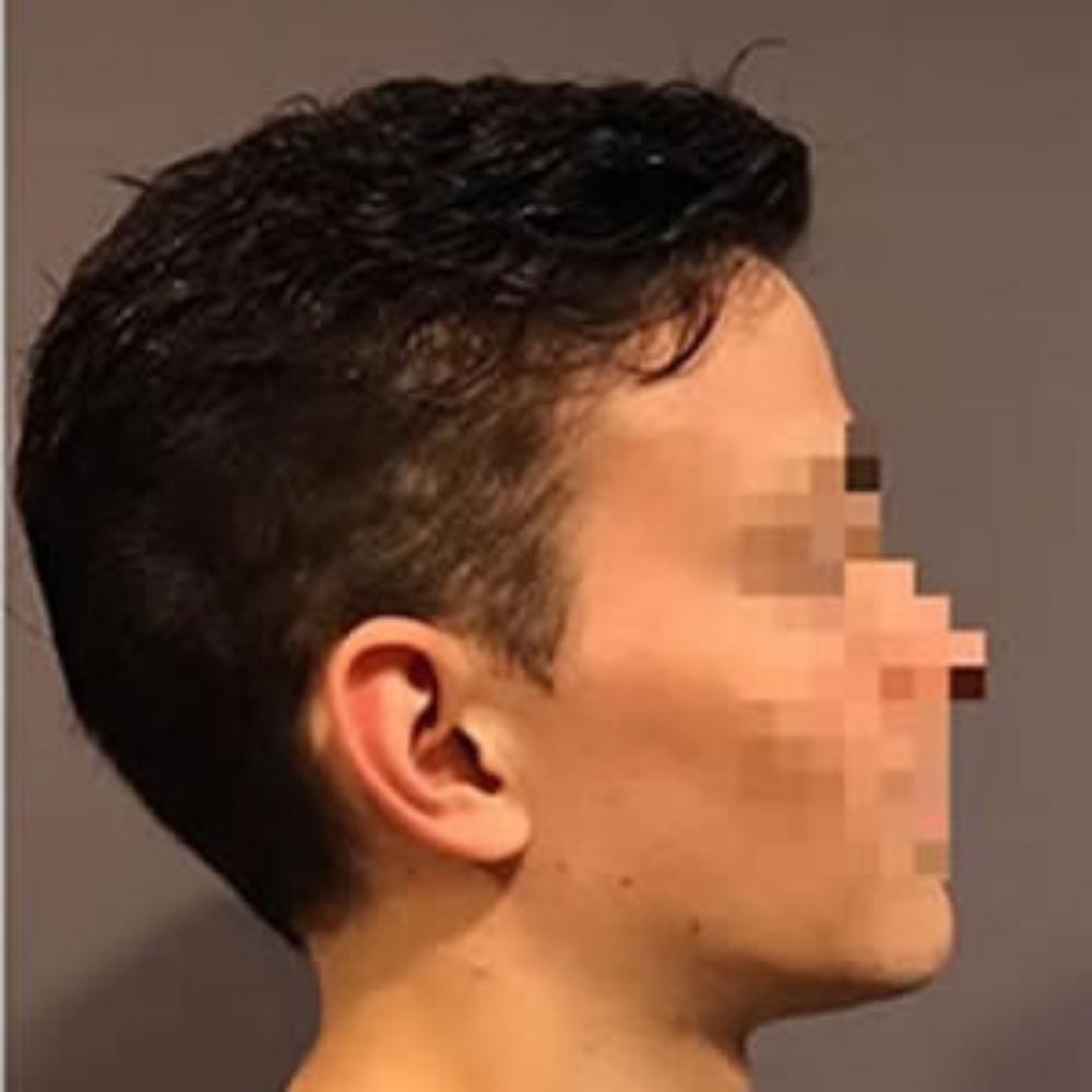 Men's Hair System - After