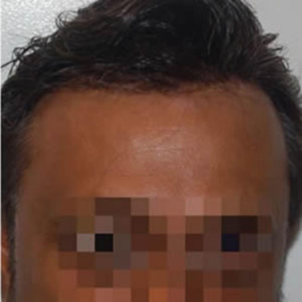 Men's Hair System - After