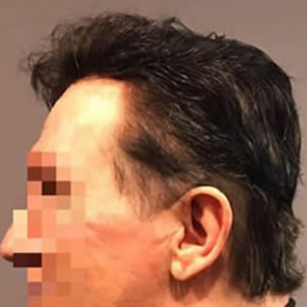 Men's Hair System - After