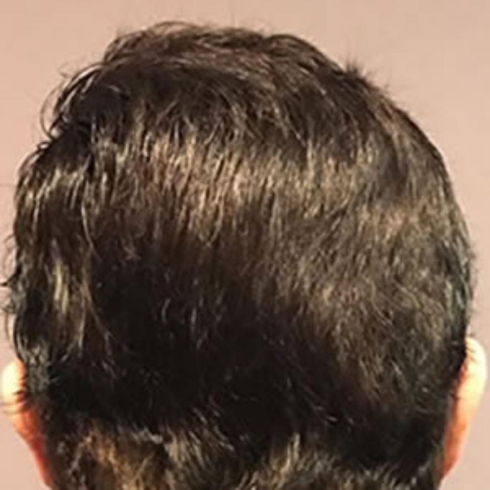Men's Hair System - After