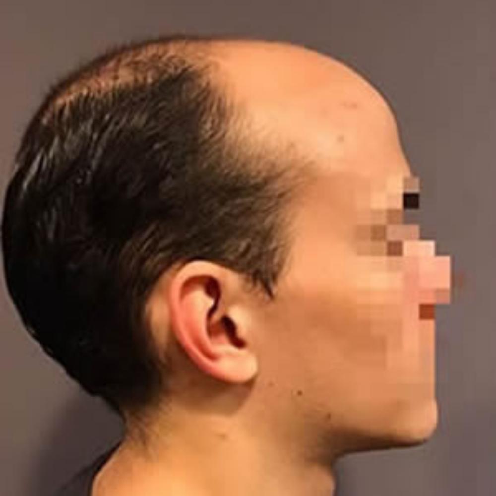 Men's Hair System - Before