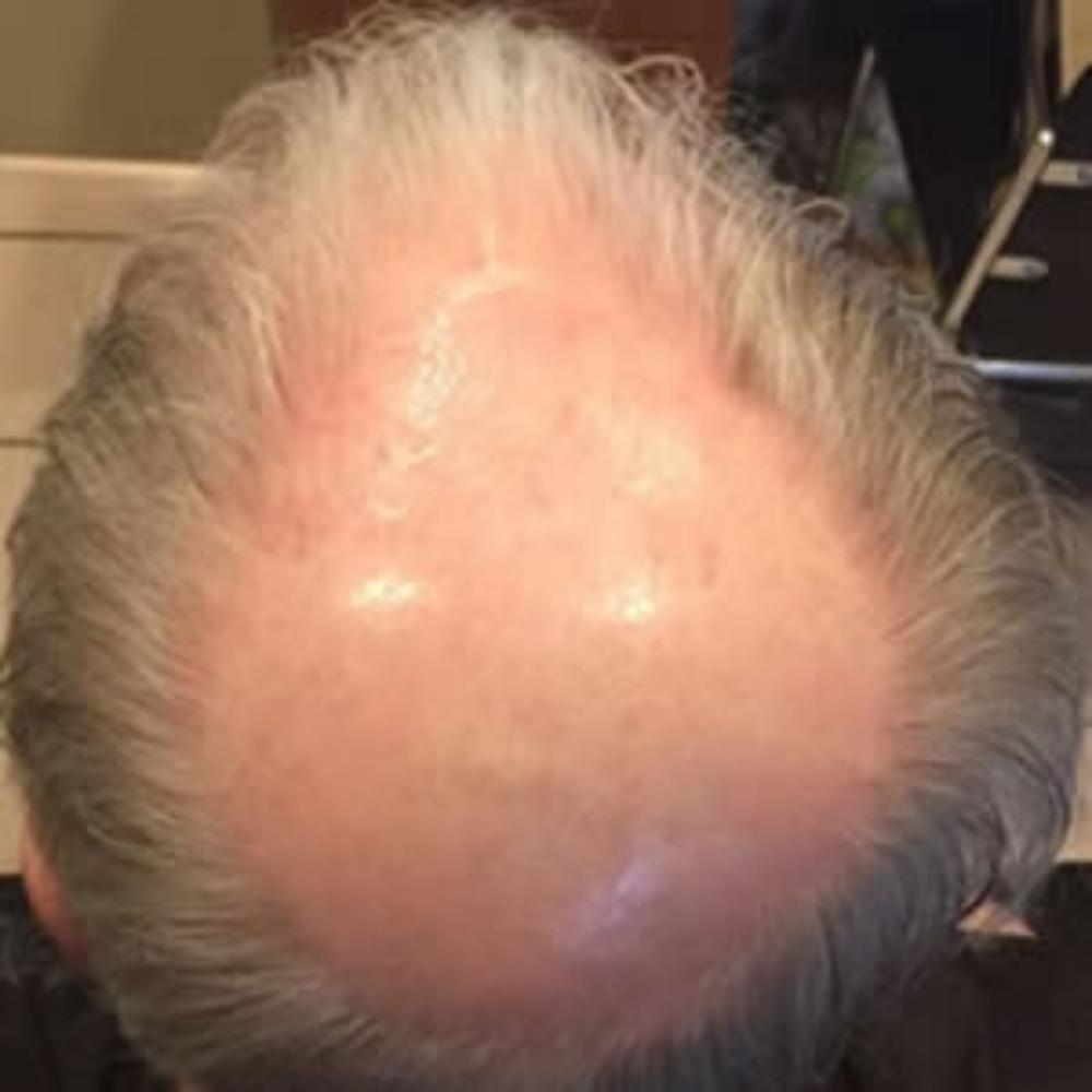 Men’s Hair System – Before Men's Hair System - Before